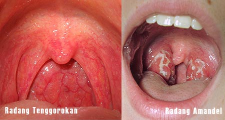 Radang Tenggorokan dan Radang Amandel